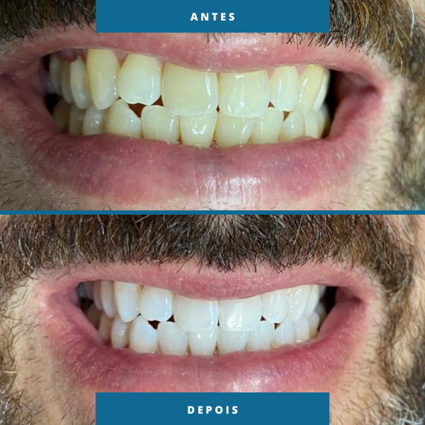 Antes e depois 1