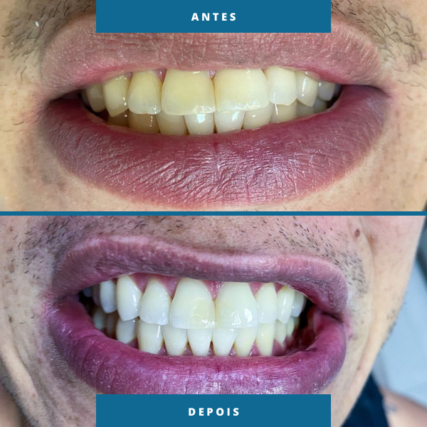 Antes e depois 2