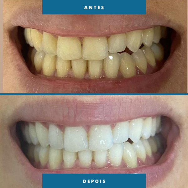 Antes e depois 3