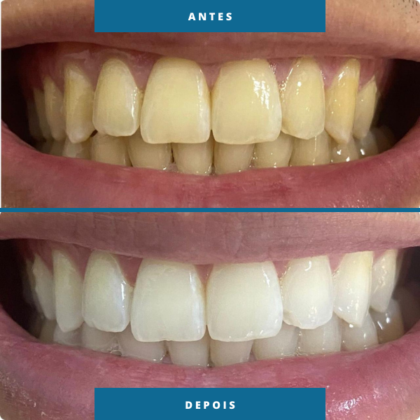 Antes e depois 4